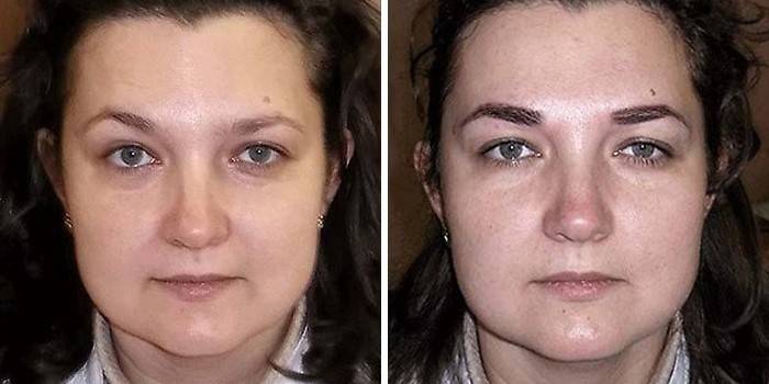 Visage avant et après