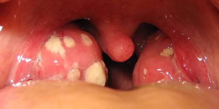 Paratonsillar abscesas
