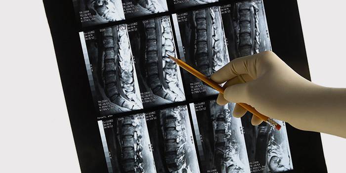 MRI της σπονδυλικής στήλης για τη διάγνωση του τσιμπημένου νεύρου