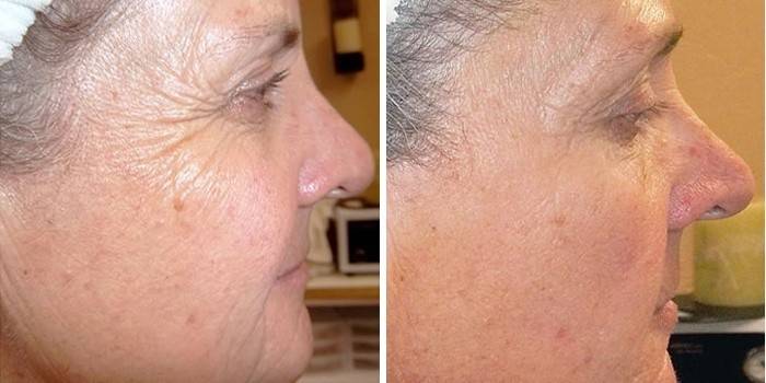 Skin before and after retinoic peeling