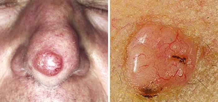 Carcinoma cutaneo a cellule basali