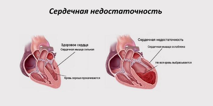 Акутна коронарна инсуфицијенција срца