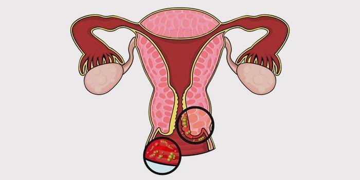 Infiammazione della mucosa vaginale