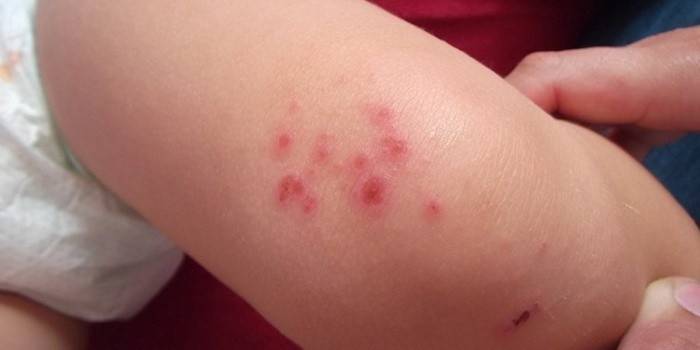 Dermatitis en un niño