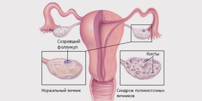 Cisti ovarica follicolare