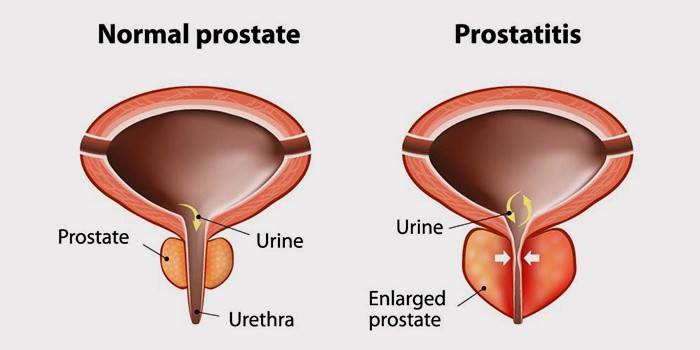 Cos'è la prostatite