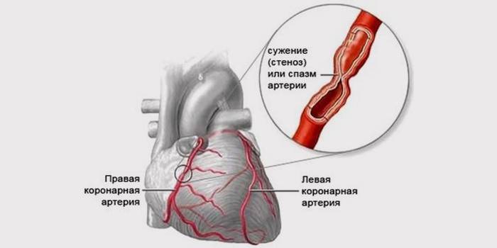 Узрок акутне коронарне инсуфицијенције
