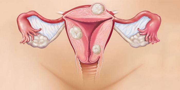 Uterusmyome mit Wechseljahren