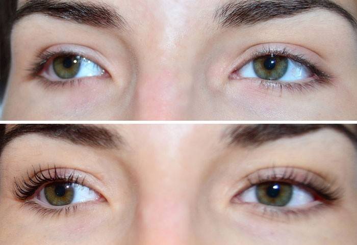 Yeux de la fille avant et après la procédure