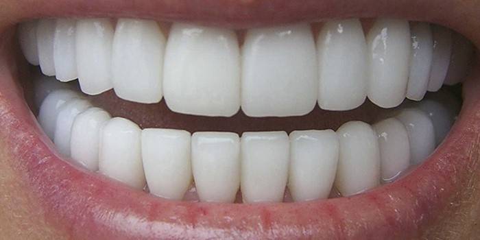 Dents blanches comme neige