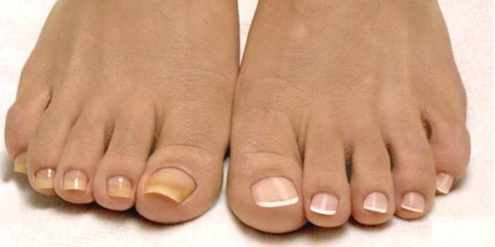 Un exemple d'infection fongique