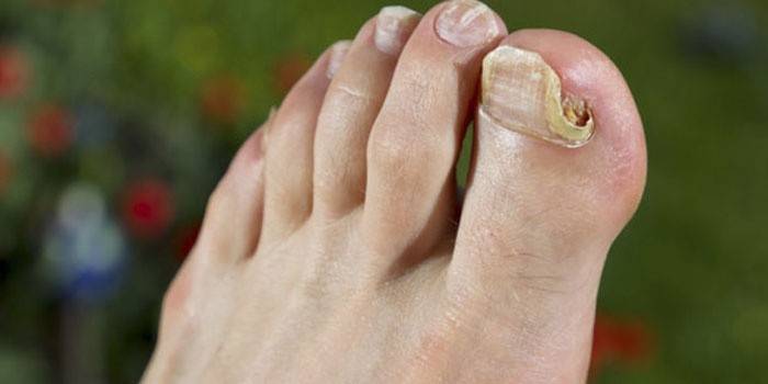 Unghiile infectate cu fungii