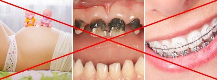 Contre-indications au blanchiment des dents