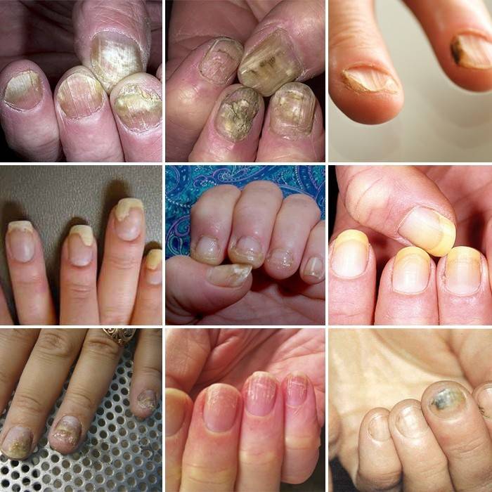 Nấm móng trông như thế nào
