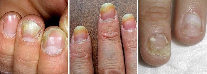 giai đoạn bệnh nấm móng