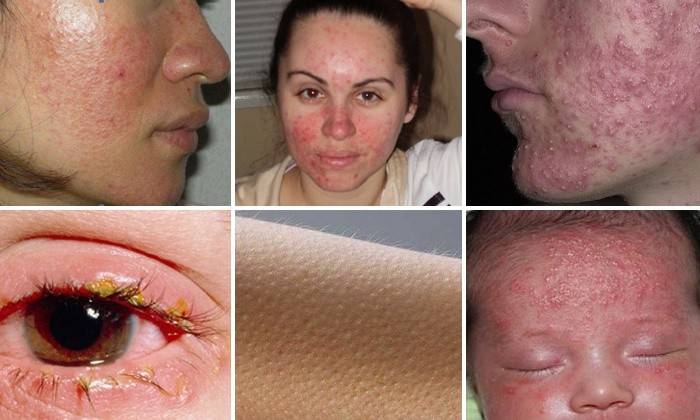 Demodex στο πρόσωπο