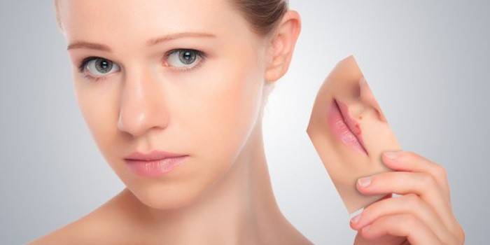La ragazza guarì rapidamente l'herpes sulle labbra