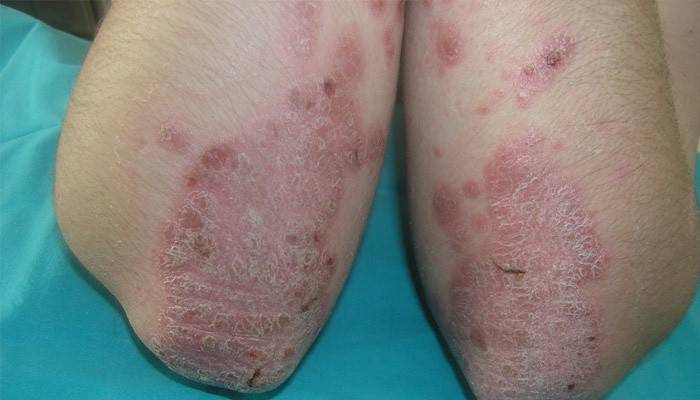 Pustulinė plaštakų psoriazė