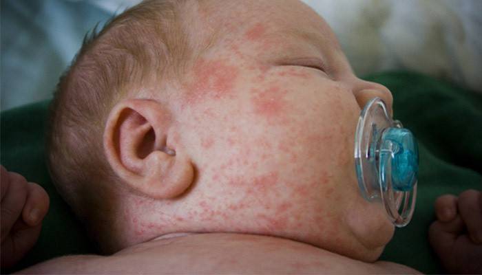 Sepsi in un neonato