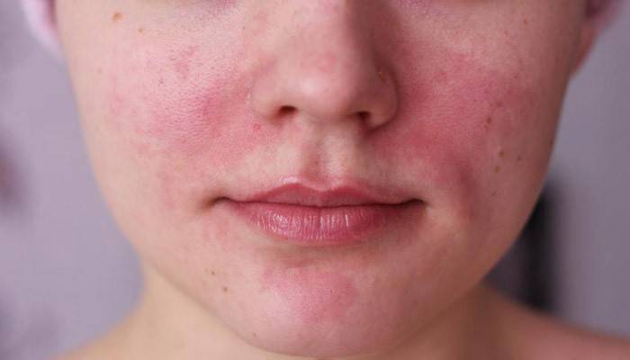 Rosacea neye benziyor