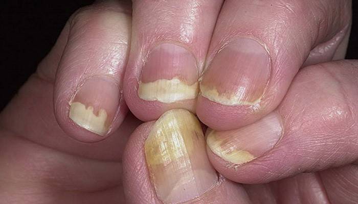 Segni di psoriasi sulle unghie