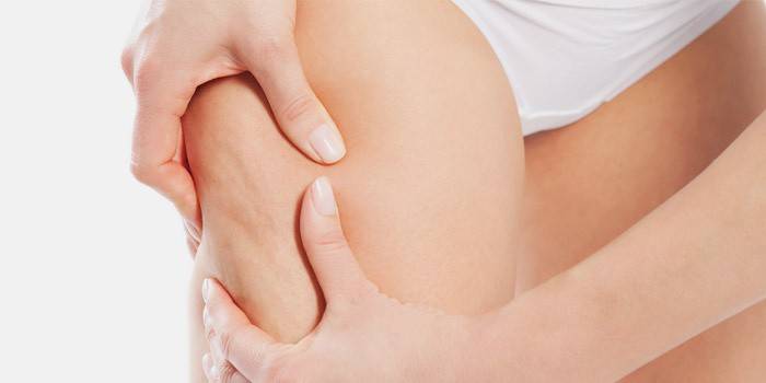 Cellulite trên chân