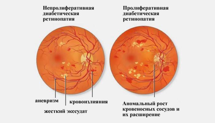 Retinopatian vaiheet sokeritaudissa