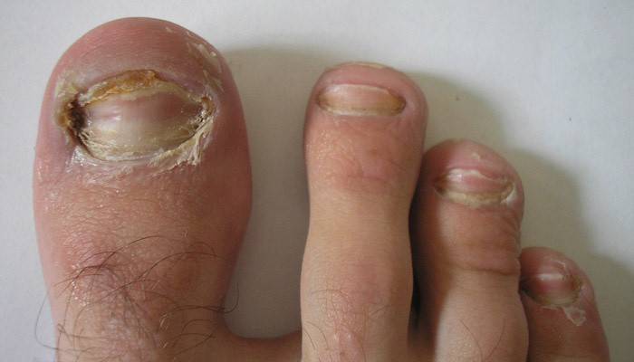 Toenail-sieni