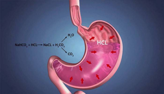 Représentation schématique d'un estomac humain présentant des signes de reflux gastro-oesophagien
