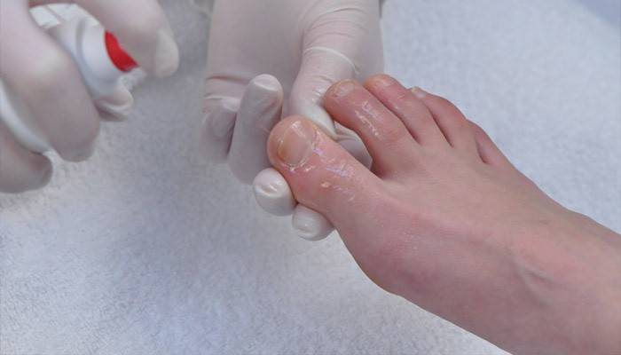 Traitement de l'ongle touché