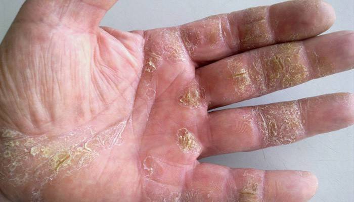 Pustulinė delno psoriazė