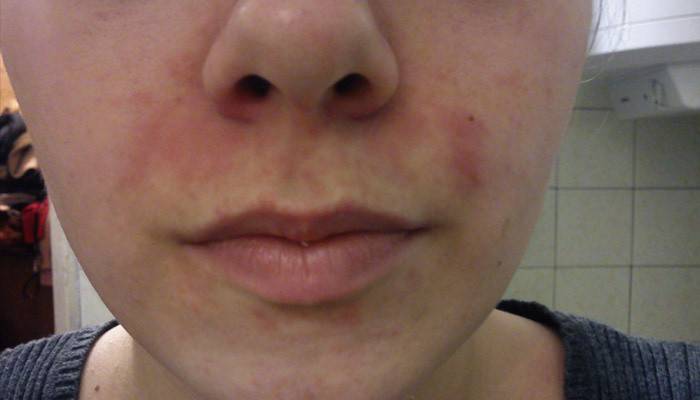 Rosacea simptomai ant veido