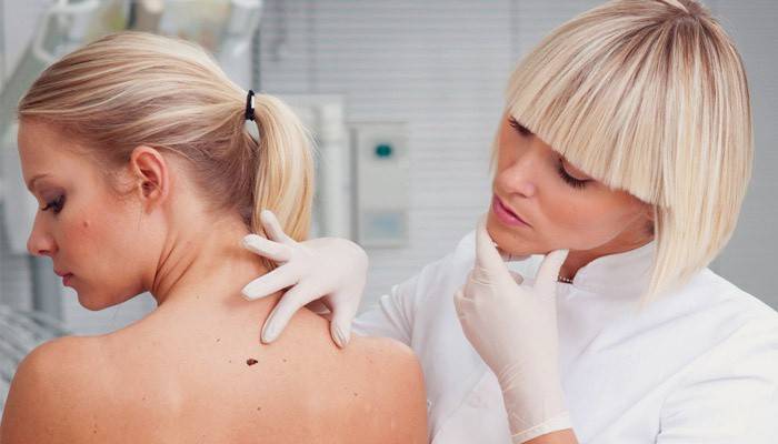 Dermatologas tiria papilomą ant mergaitės kūno