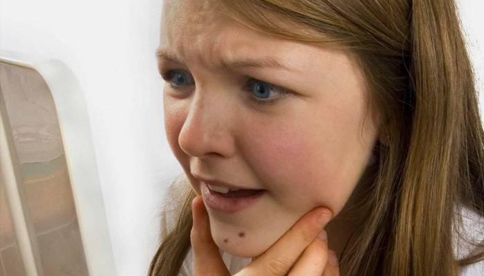 A lány seborrheás dermatitist fedezett fel