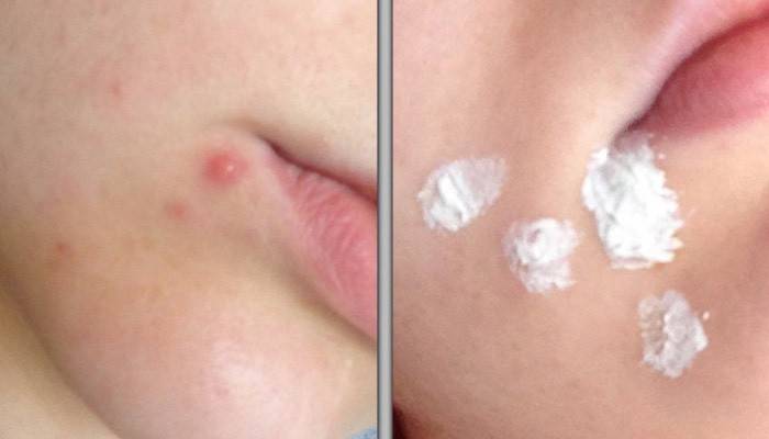 Anvendelse af zinkpasta til behandling af acne