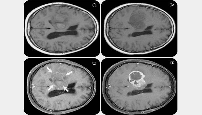 MRI của não