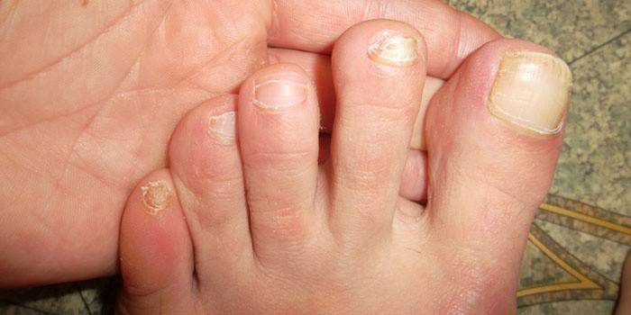 Unghie dei piedi colpite dal fungo