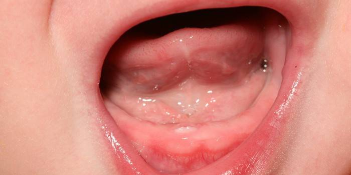 Hematomas e outras possíveis doenças da gengiva em bebês