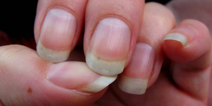I primi segni di fungo delle unghie sulle mani