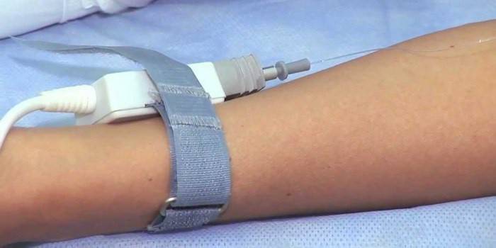 Lazer kan temizliği için kelepçeler