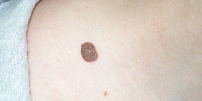 Papilloma sul corpo umano