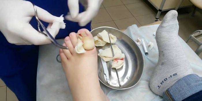 Rimozione chirurgica di un'unghia del piede