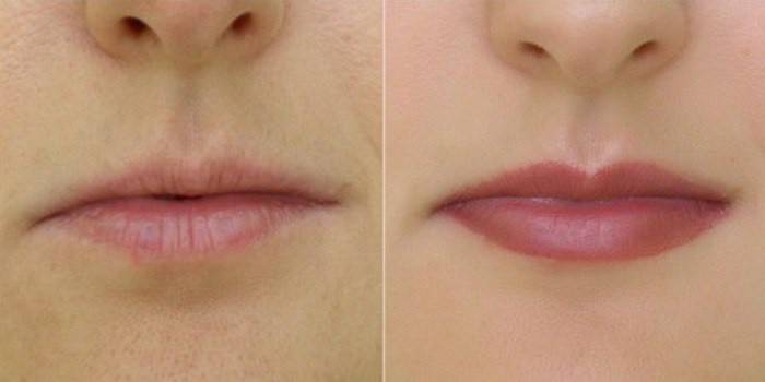 Chỉnh sửa môi không đối xứng bởi chủ xăm