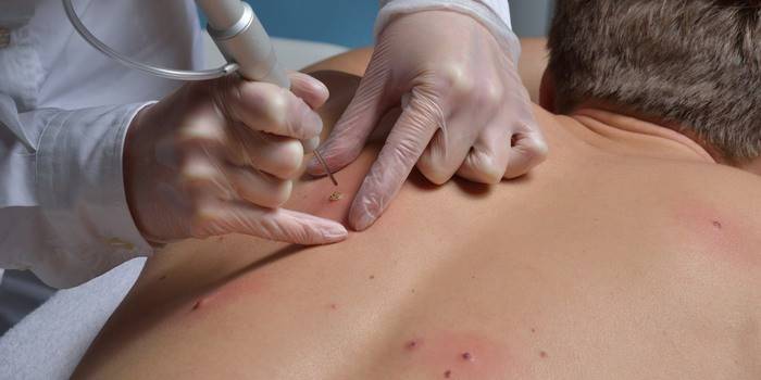 Rimozione del papilloma laser