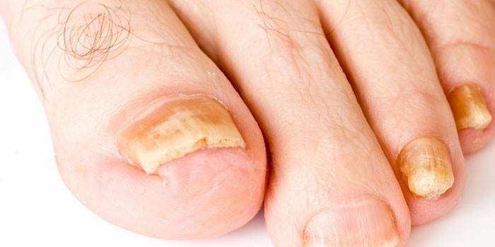 Μύκητας νυχιών toe