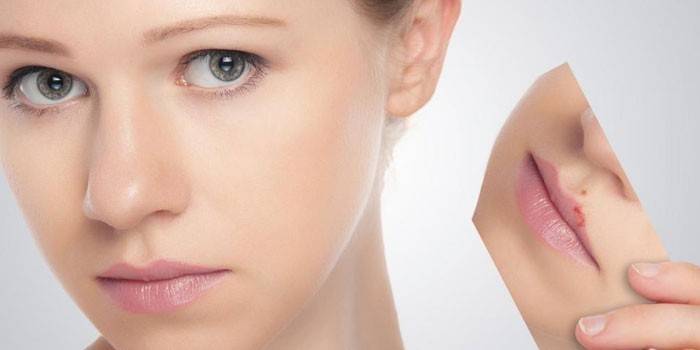 Herpes vīrusa ārstēšanas rezultāts uz lūpām