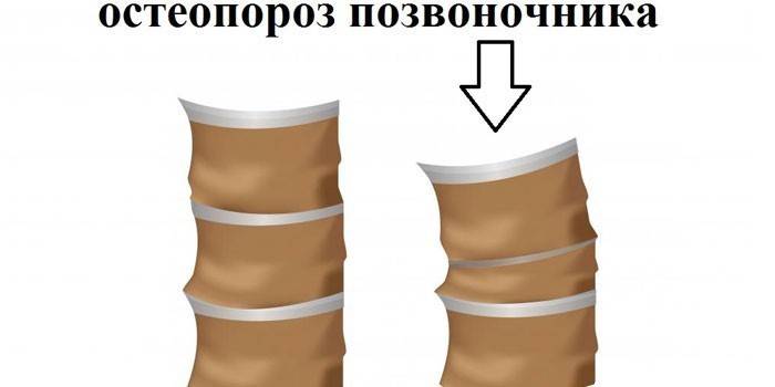 Stuburo kaulų tankio mažinimo schema