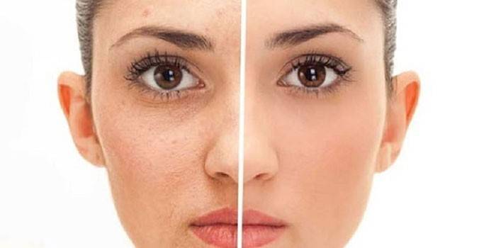 Ferul Peeling Résultat