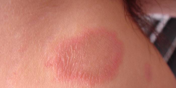 Pityriocation nhiều màu