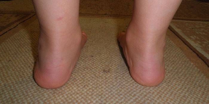 עיוות שטוח של valgus בכף הרגל